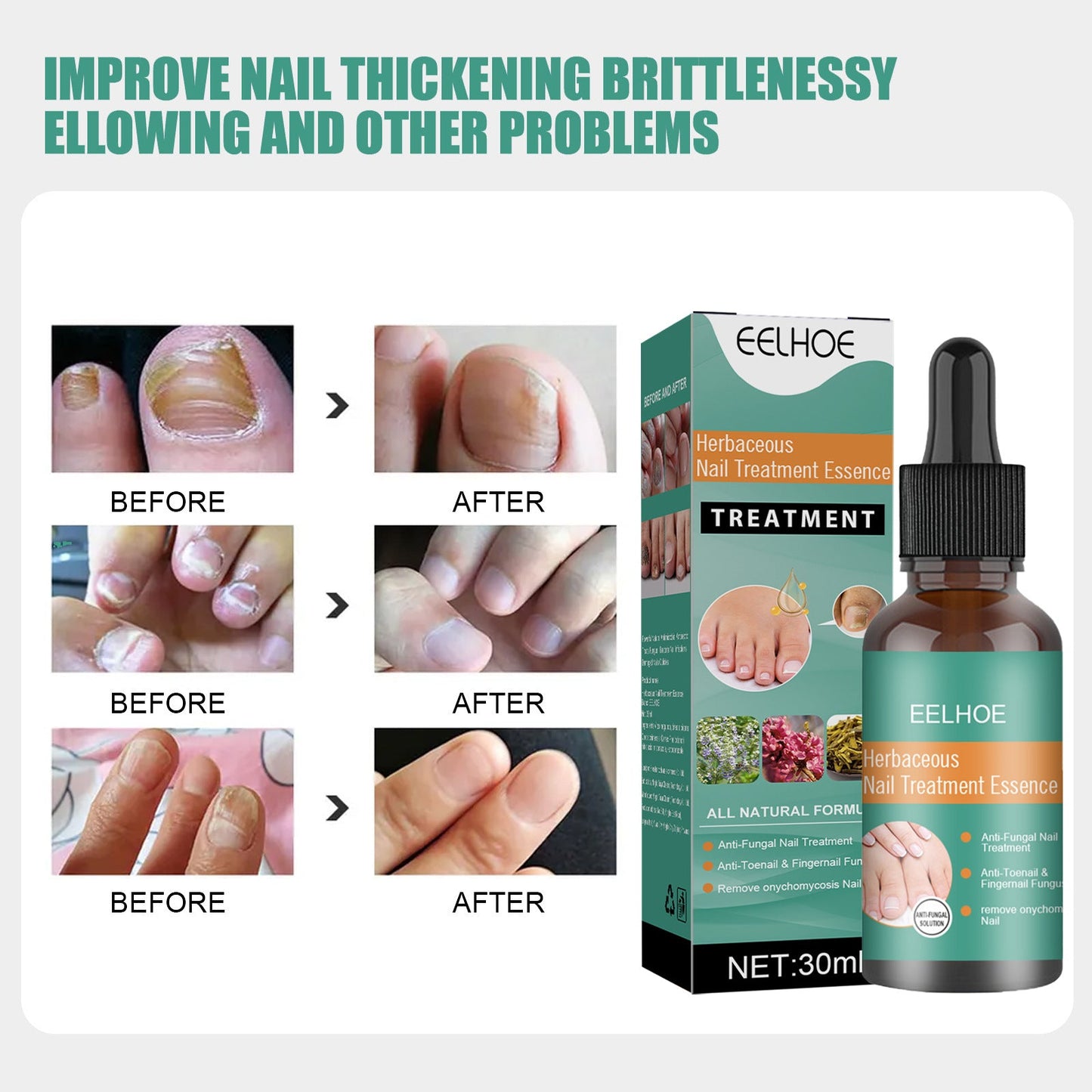 EELHOE Nail Repair Solution Strengthen and Restore Thick, Smooth and Healthy Nails
