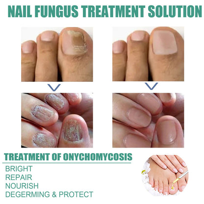 EELHOE Nail Repair Solution Strengthen and Restore Thick, Smooth and Healthy Nails